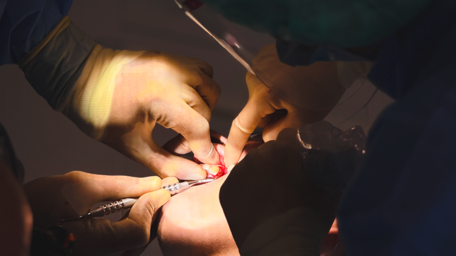 Can Dental Implants Fall Out?