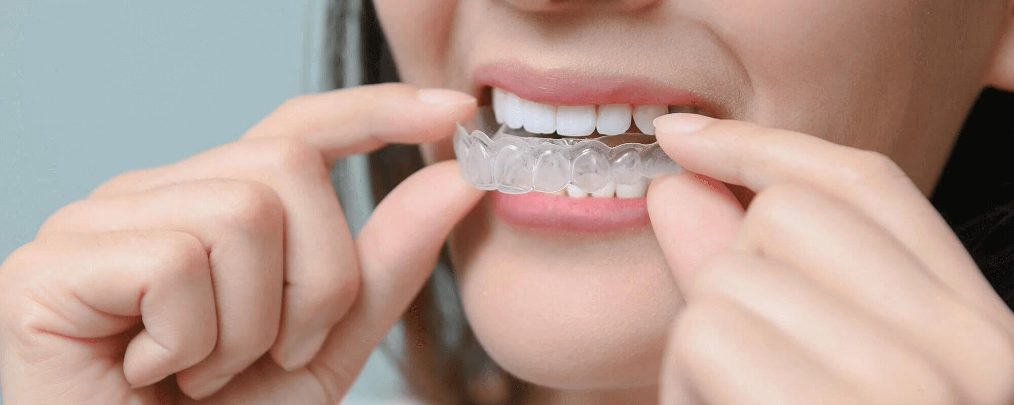 Invisalign Treatment Process: A Complete Guide