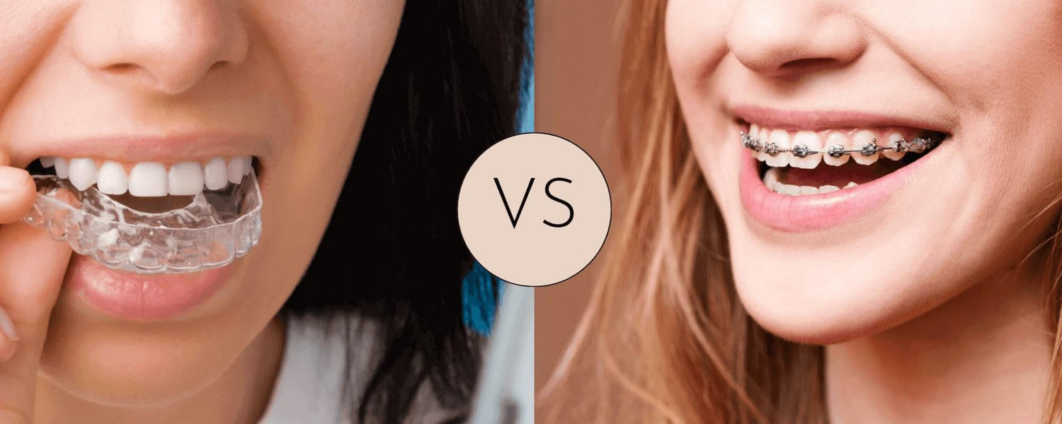 Invisalign Vs. Metal Braces