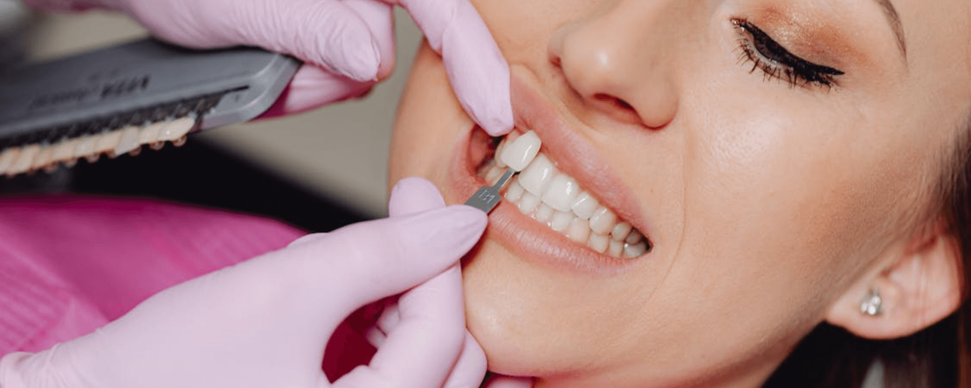 Are You a Good Candidate for Veneers? Key Signs to Consider