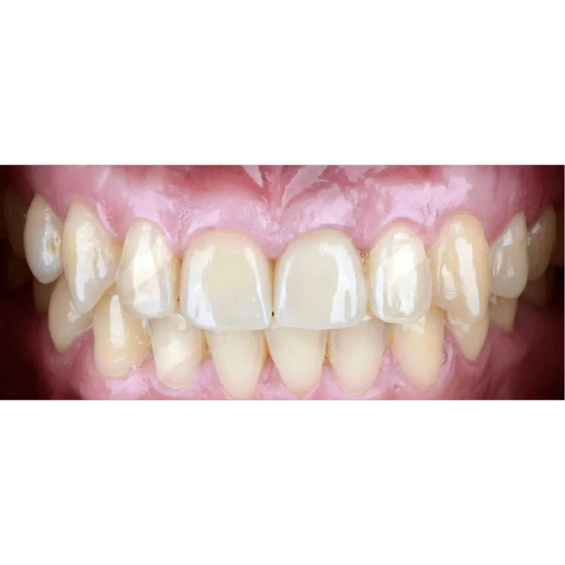 After Single Tooth Dental Implant