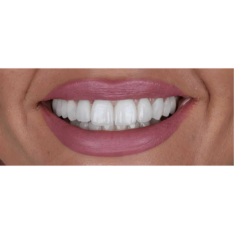 After Multi Teeth Dental Implants