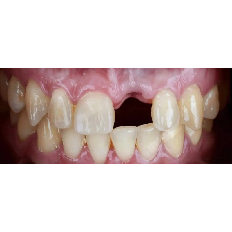 Before Single Tooth Dental Implant