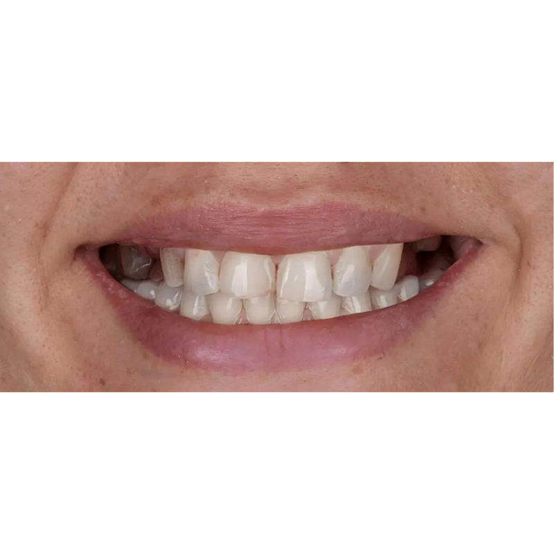 Before Multi Teeth Dental Implants