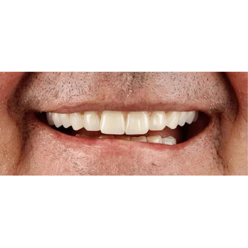After Single Arch Dental Implants