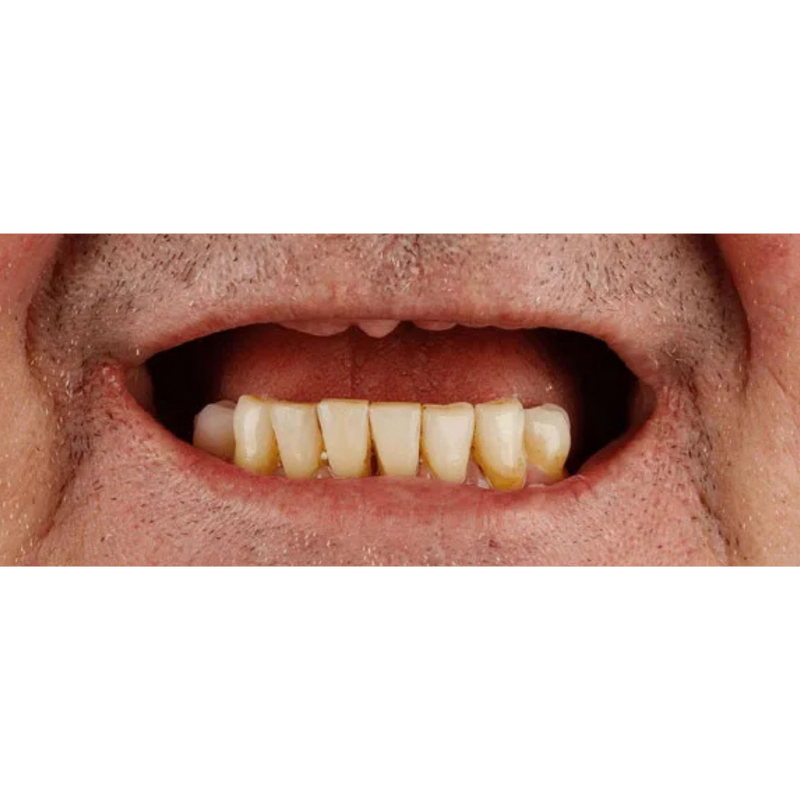 Before Single Arch Dental Implants
