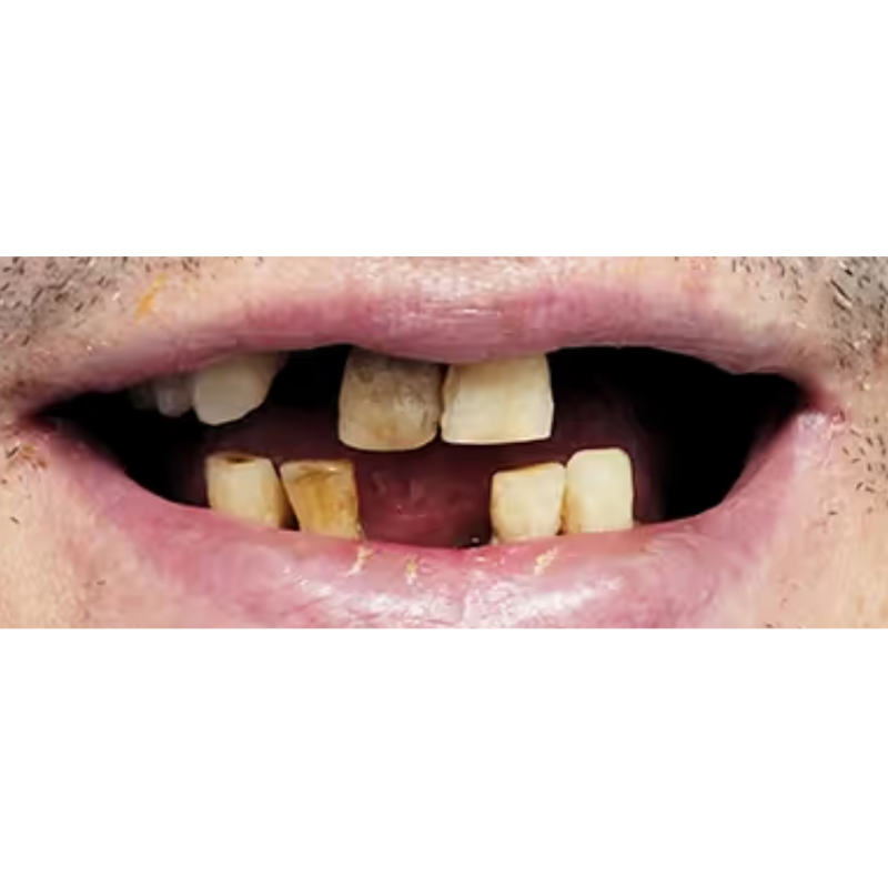 Before Full Smile Dental Implants