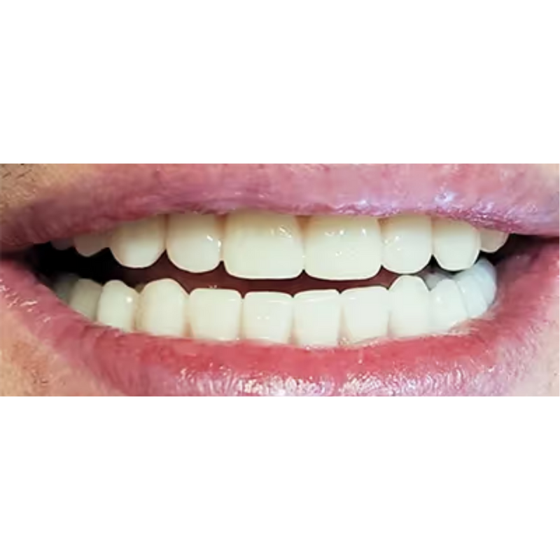 After Full Smile Dental Implants