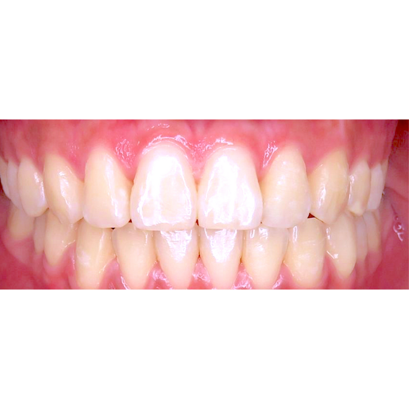 After 12 week transformation with Invisalign