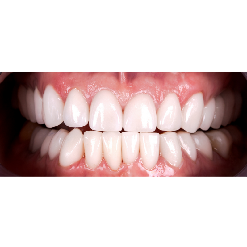 After 12 week transformation with Invisalign