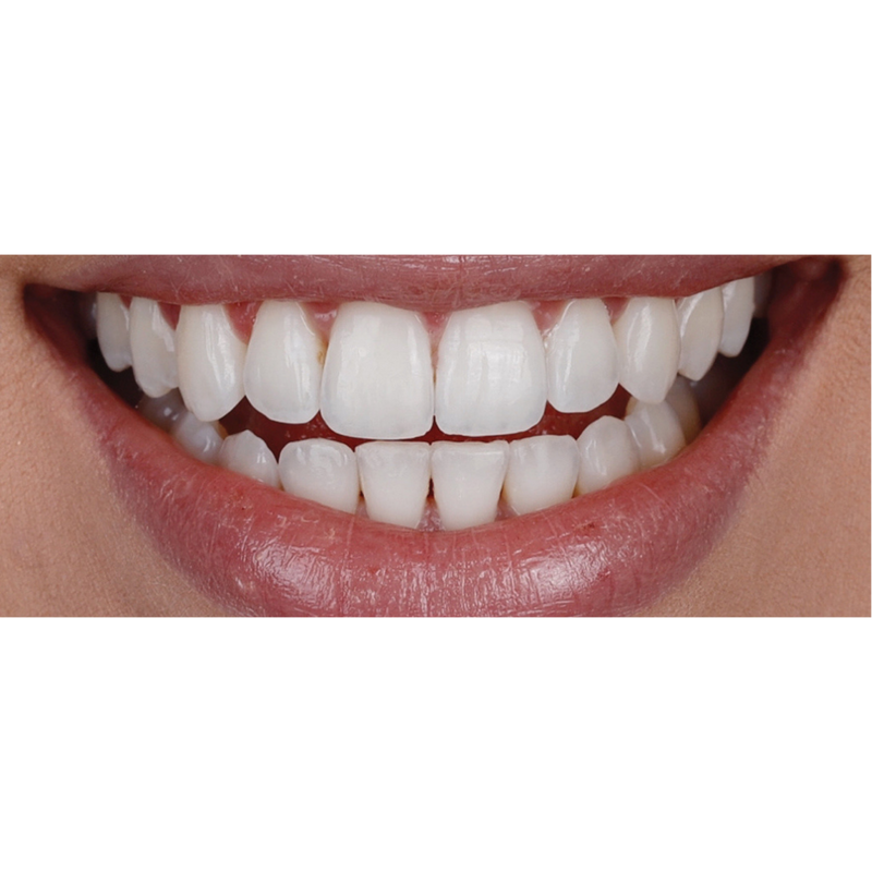 After 12 week Transformation with Invisalign