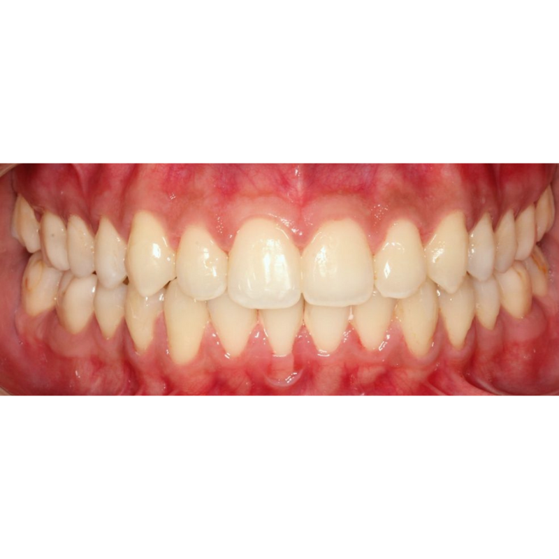 After 12 week transformation with Invisalign