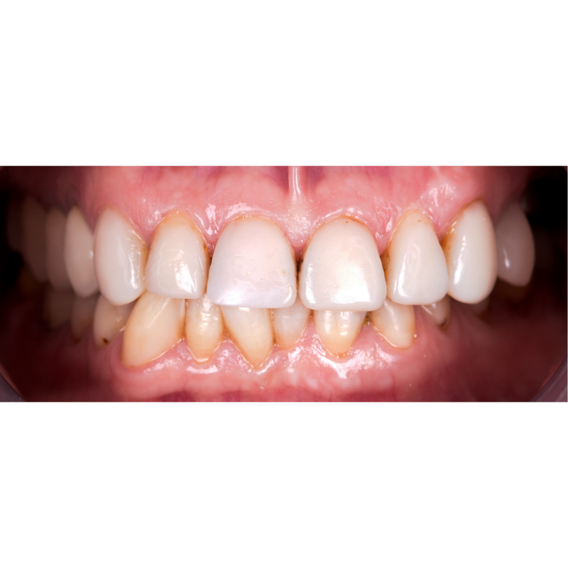 Before 12 week transformation with Invisalign
