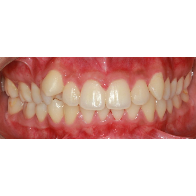 Before 12 week transformation with Invisalign