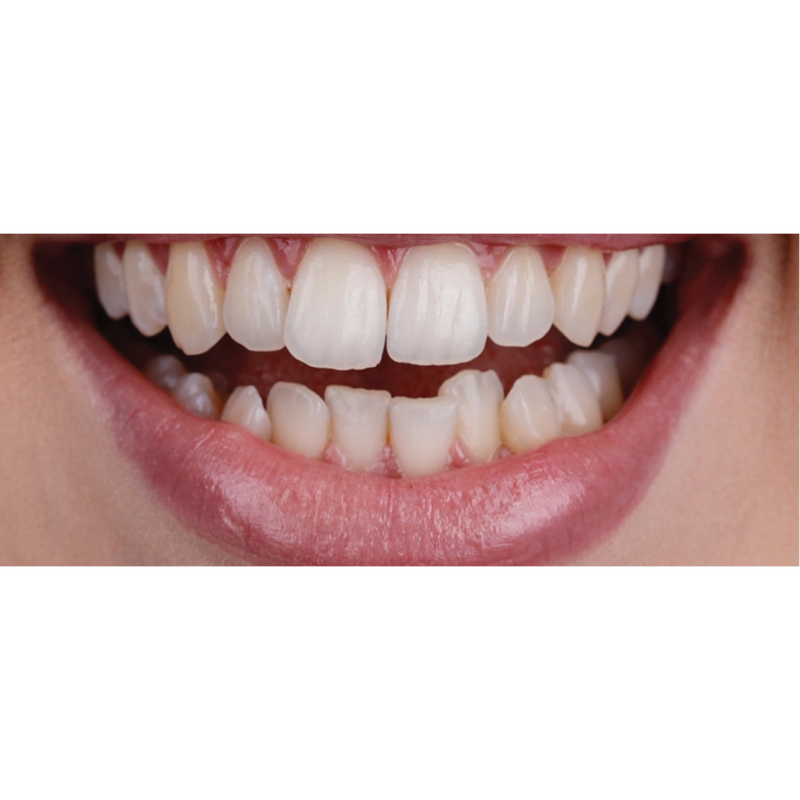Before 12 week Transformation with Invisalign