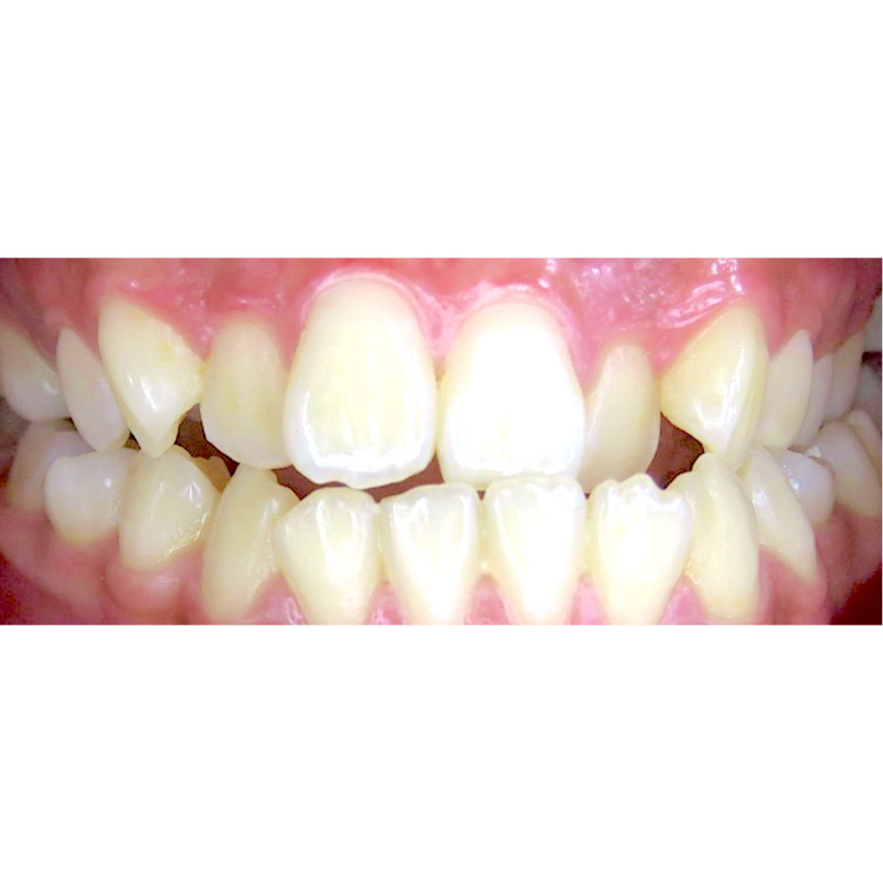 Before 12 week transformation with Invisalign