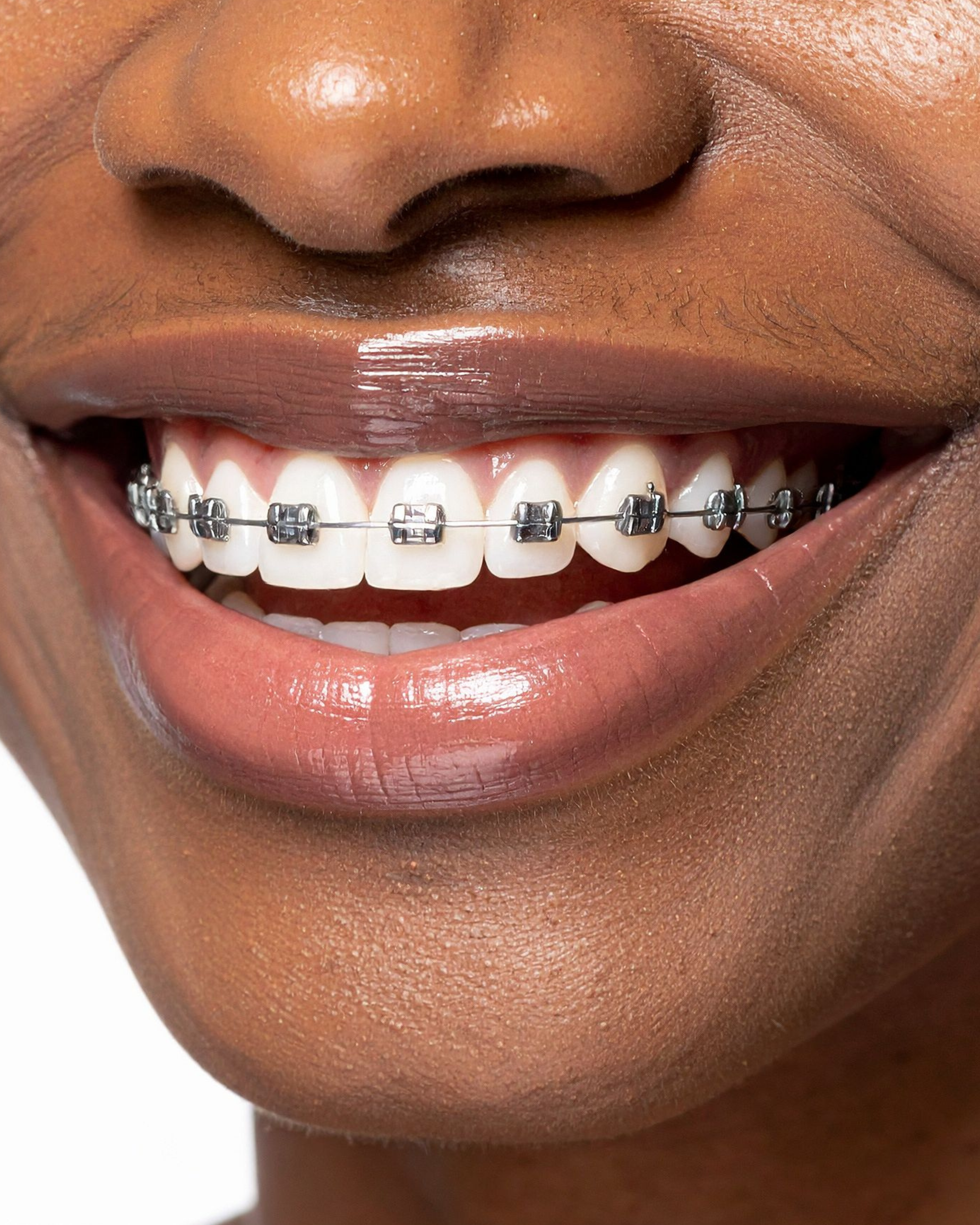 Fixed braces option is available at Stella Dental
