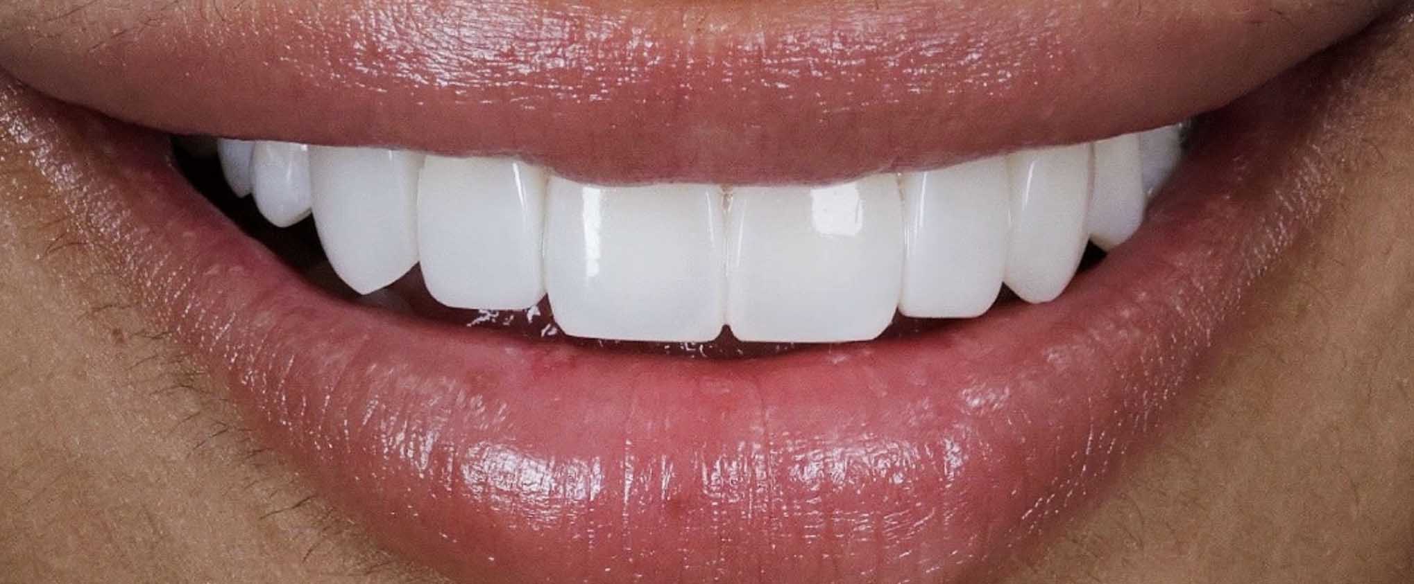 Close-up of a person's mouth with white teeth
