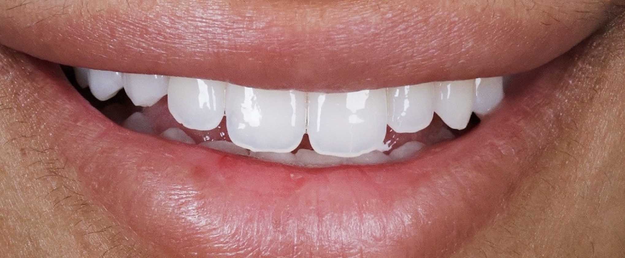 Close-up of a person's mouth with white teeth