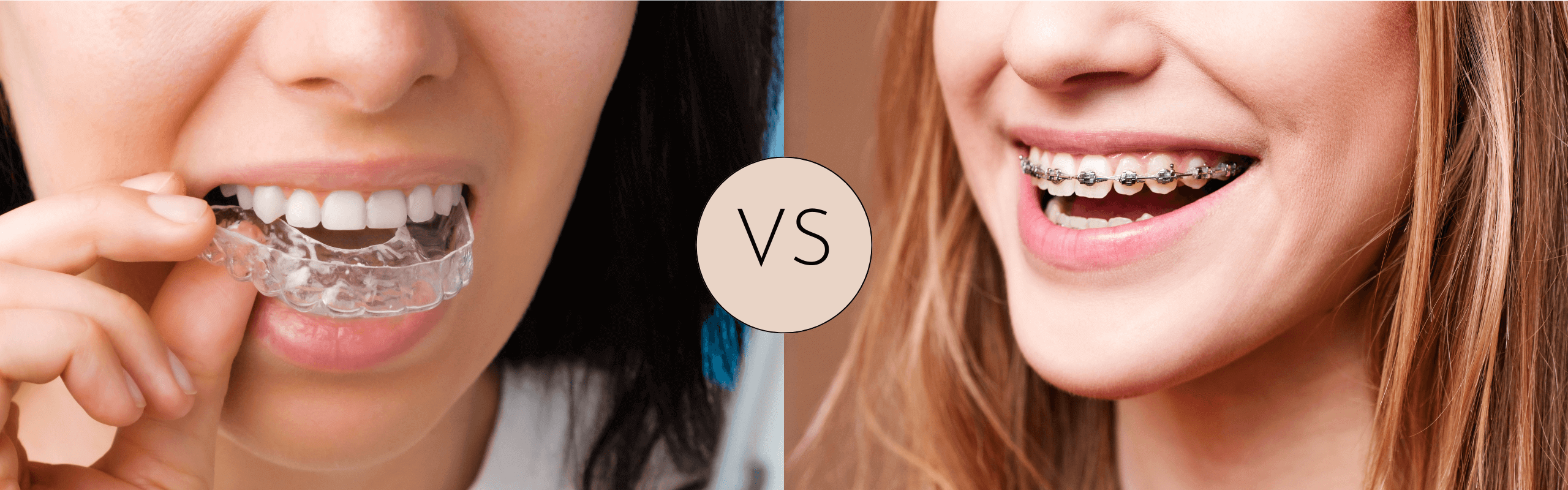 Invisalign Vs Metal Braces Stella Dental Stafford Dentist