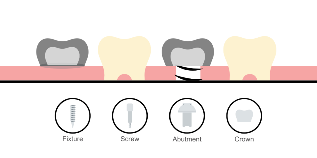 Dental implants structure - fixture, screw, abutment, crown - Stafford dental practice