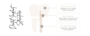 An infographic of a dental implants structure and what they are made of 